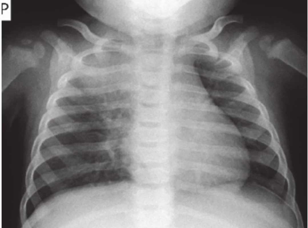 Vstupní RTG snímek plic.
Fig. 2. Chest X-ray of infant on admission.