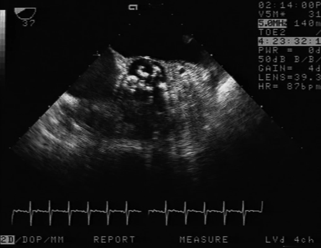 Příjem pacientky resuscitované pro arytmii, příjmové vyšetření odhalilo těsnou aortální stenózu (AVA 0,4 cm2) Jde o vyšetření TEE ze středního jícnu, nahoře levá síň, v centru těžce degenerovaná aortální chlopeň, která byla druhý den po příjmu nahrazena protézou.