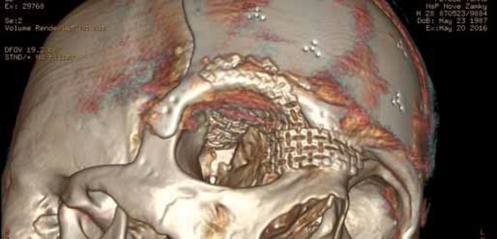 Detailný pohľad 3D CT rekonštrukcie na oblasť koreňa nosa, okraja orbity, ktoré boli domodelované použitím 3D titánovej sieťky.
Fig. 6. Detailed 3D CT reconstruction depicting radix nasi area and the orbital margins shaped using 3D titanium mesh.
