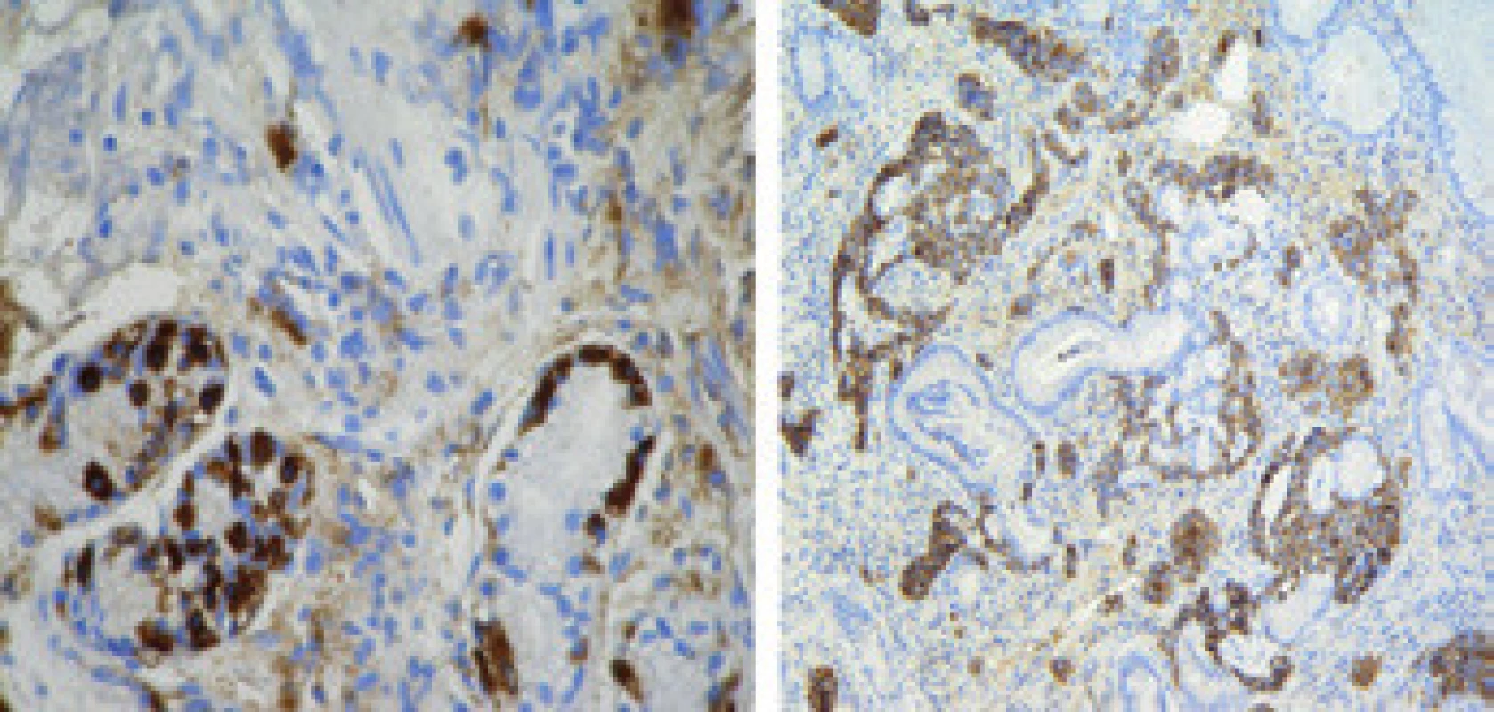 Histologické vyšetření lézí v těle a fundu žaludku.

