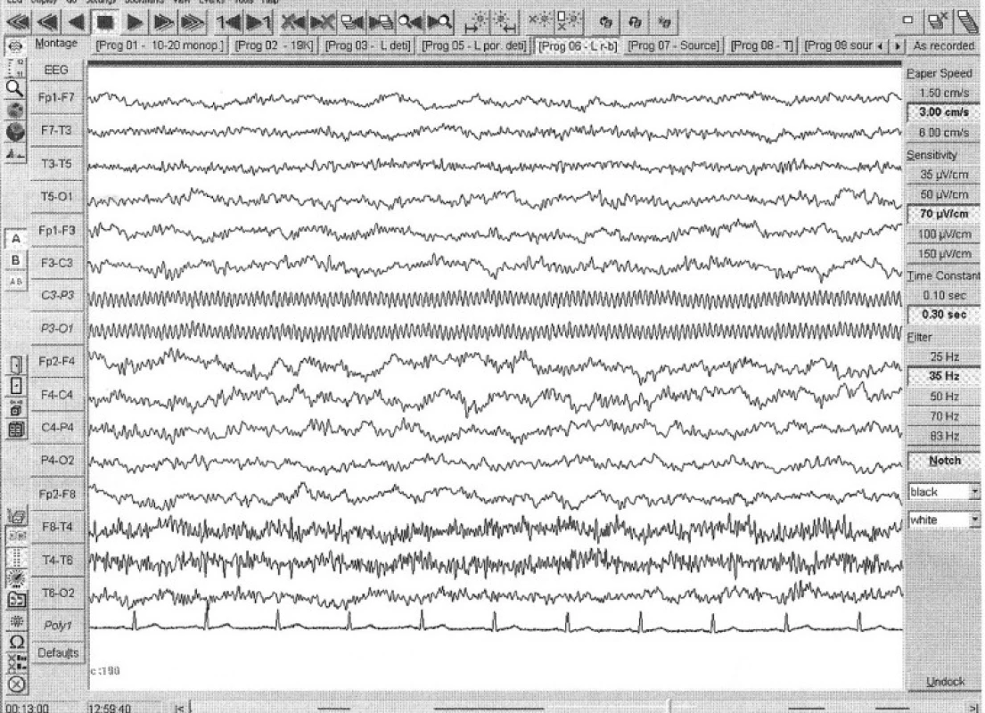  EEG