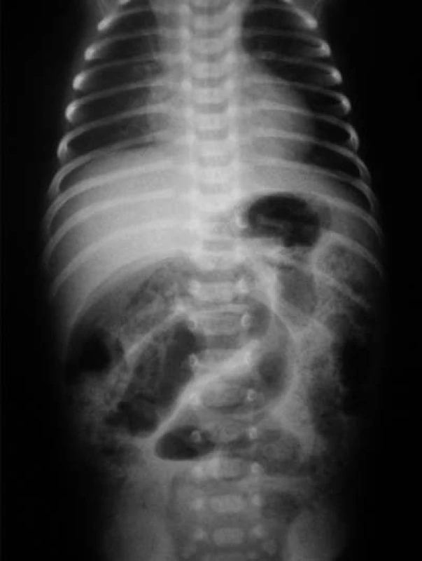 Pneumatóza čreva – drobné „bublinkové“ prejasnenia v črevnej stene. Obraz patognomický pre NEC.
Fig. 1. Pneumatosis of intestine – minute “bubble” clearing in the intestinal wall: The picture is pathognomic for NEC.