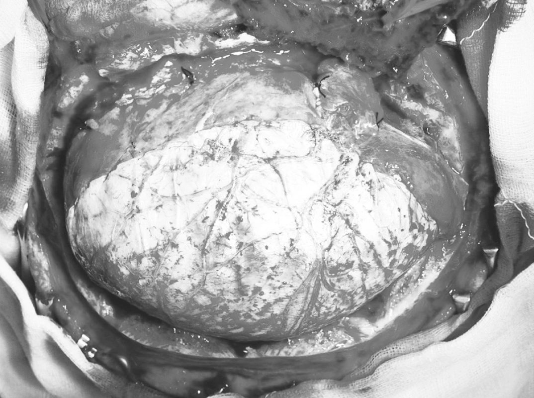 Plastika defektu tvrdé pleny štěpem periostu
Pic. 8. Reconstruction of the dural defect using a periosteal Grapht