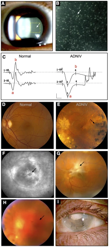 ADNIV phenotype.