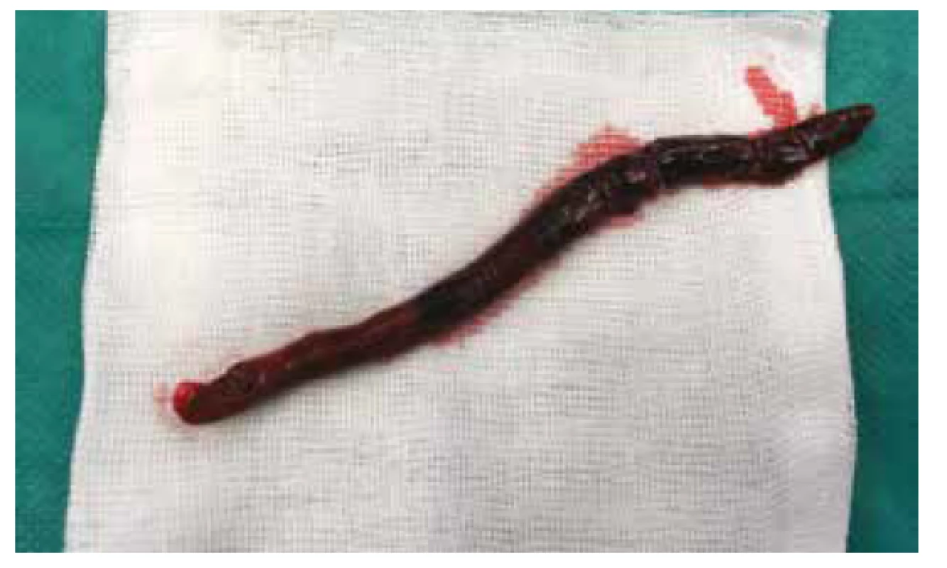 Embolus odstraněný z pravé a. subclavia<br>
Fig. 2: Embolus extracted from the right subclavian artery