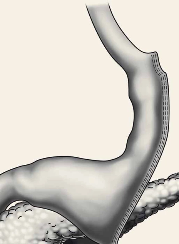Sleeve gastrectomy.
Fig. 4. Sleeve gastrectomy.