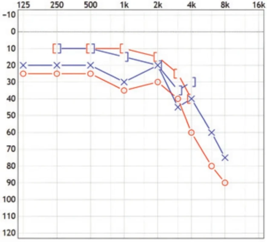 Kontrolní audiogram rok po operaci, téměř úplný uzávěr kochleární rezervy. Fig. 8. Follow-up audiogram one year after surgery showing nearly complete closure of the airbone gap.