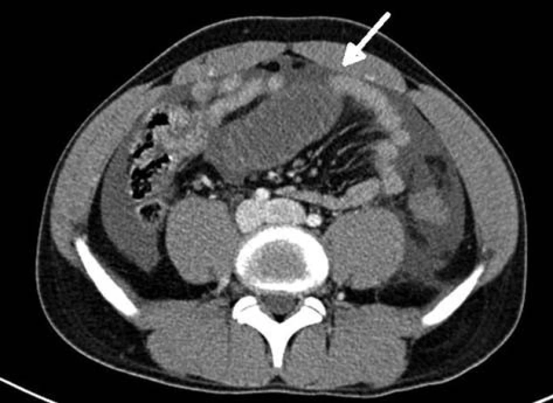 Transverzální CT ukazující přechod distendované a kolabované kličky (šipka)
Fig. 3: Transverse CT – transitional point between the distended loop and the collapsed loop (arrow)