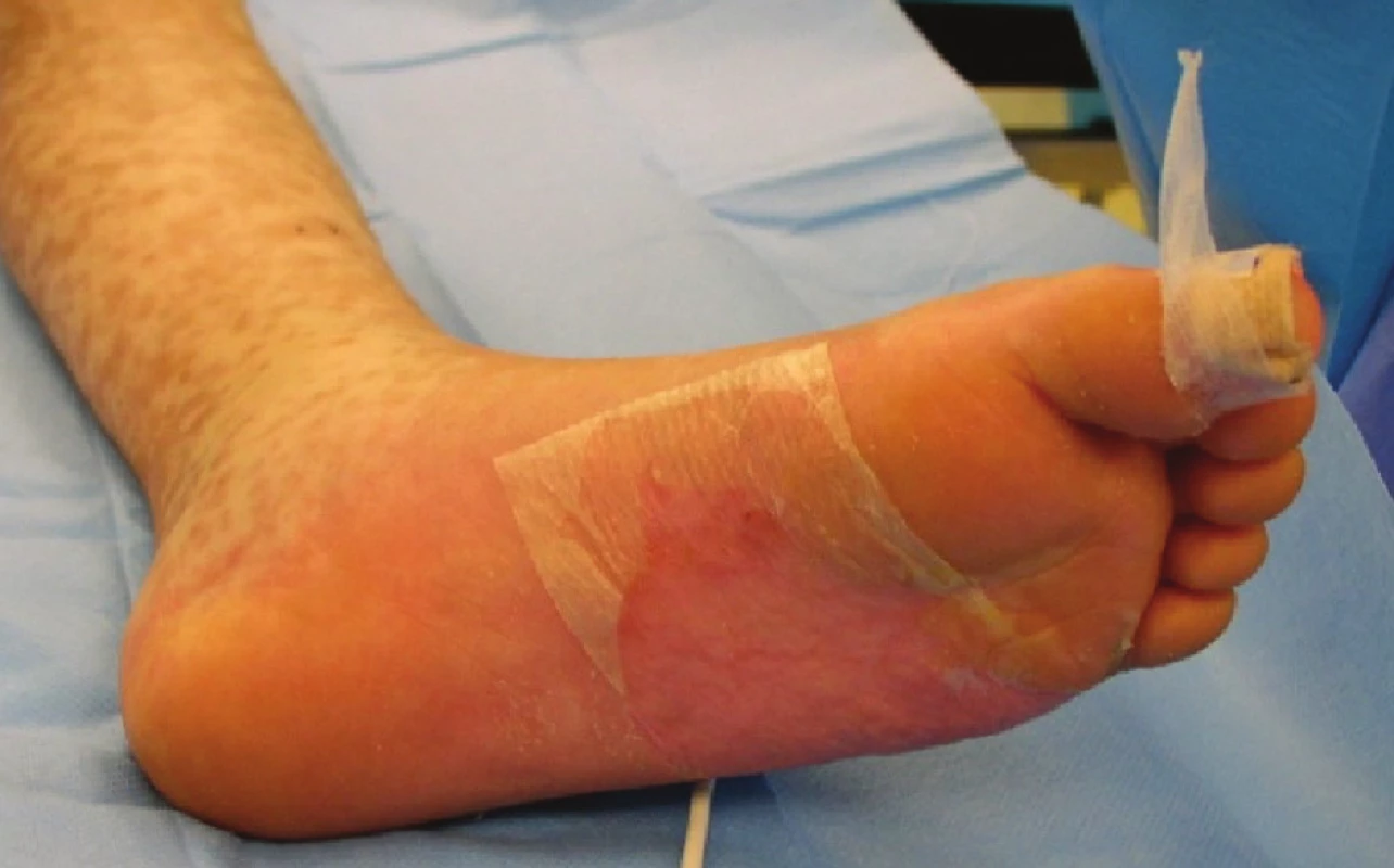 Exfoliované plochy kryté xenotransplantáty na plosce levé nohy
Fig. 6: Exfoliated areas covered with xenotransplants on the sole of the left foot