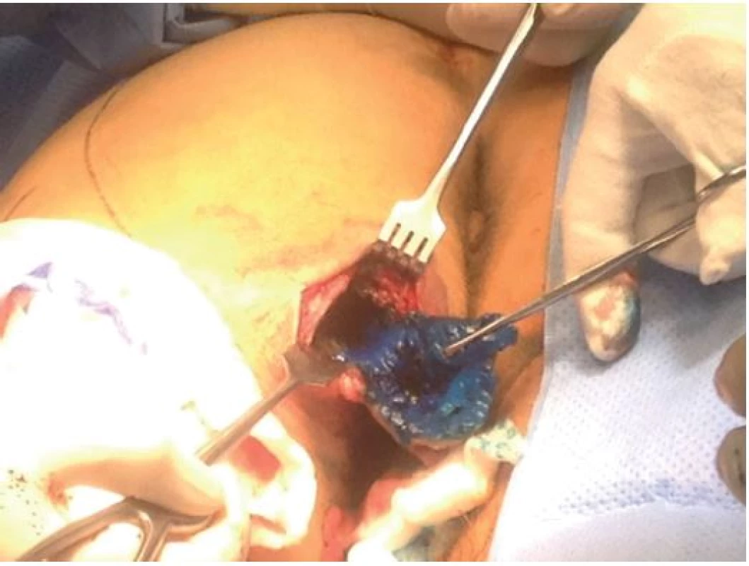 Exstirpace pseudocysty pomocí značení pattent blau
Fig. 4: Extirpation of the pseudocyst using pattent blau marking