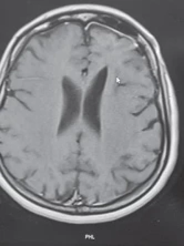 Shows the post-operative MRI. Obr. 2. Zobrazuje pooperační MR snímek.