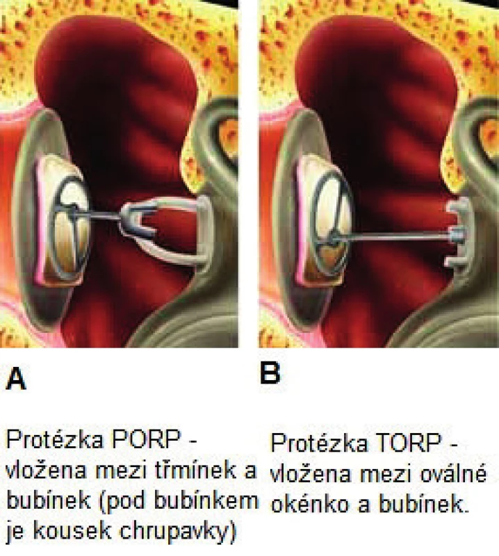 A, B. Rekonstrukce převodního systému středního ucha pomocí titanových protéz.
Fig. 9. A, B. Reconstruction of the middle ear ossicles, titanium prosthesis.