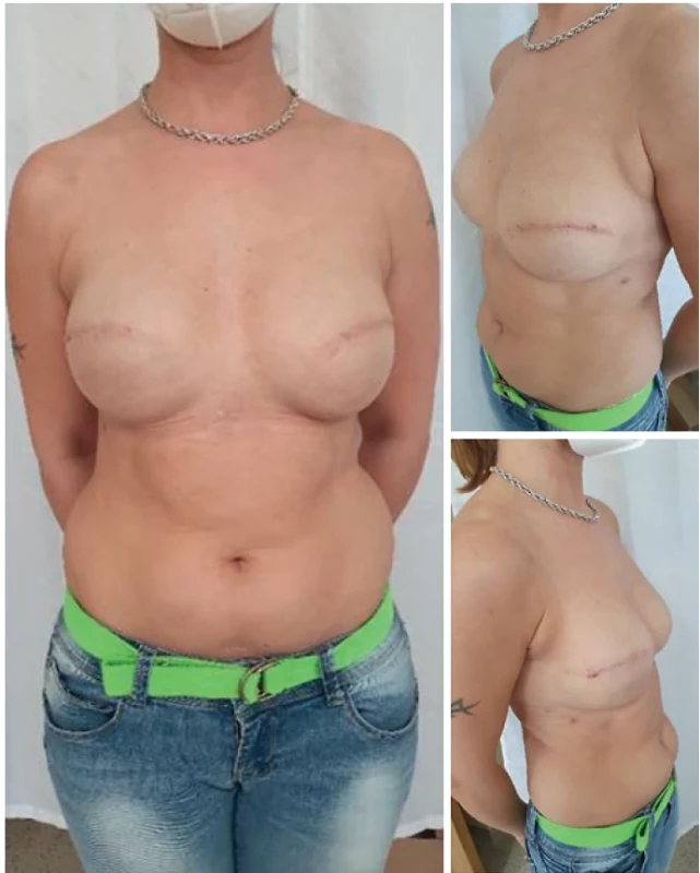 Aloplastická rekonstrukce prsu silikonovými implantáty.