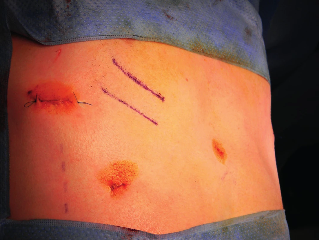 Pooperační fotografie dosažené korekce PE po zavedení a stabilizaci dlahy.
Fig. 3. Postoperative photo of the PE correction reached after introduced and stabilized bar.