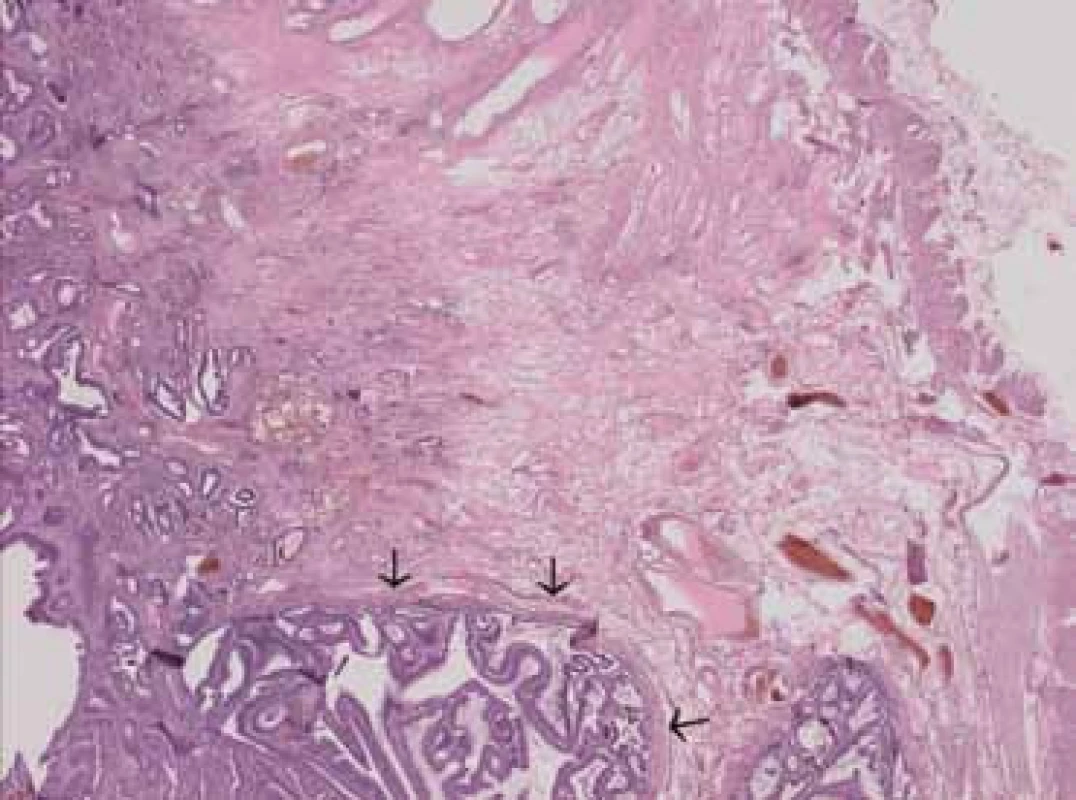 Mikroskopický preparát karcinomu rekta, šipky ukazují intaktní lamina muscularis mucosae.
Fig. 4. Microscopic slide of rectal carcinoma, intact lamina muscularis mucosae marked by arrows.
