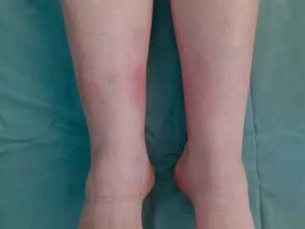 Klinický nález