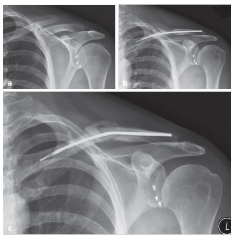 Angulace implantátu v průběhu hojení (muž K. P., 34 let)
a) úrazové snímky dvoufragmentové zlomeniny;
b) čtyři týdny po operaci s dobrým postavením kostních fragmentů i impantátu; c) pět měsíců po operaci zlomenina zhojena po angulaci implantátu
Fig. 5: Bending of the implant during healing (male K.P., 34 years)
a) X-ray of a two-fragment fracture taken after the injury; b) four weeks after surgery with good bone and implantation position; c) five months after surgery the fracture is healed after the implant wans bent