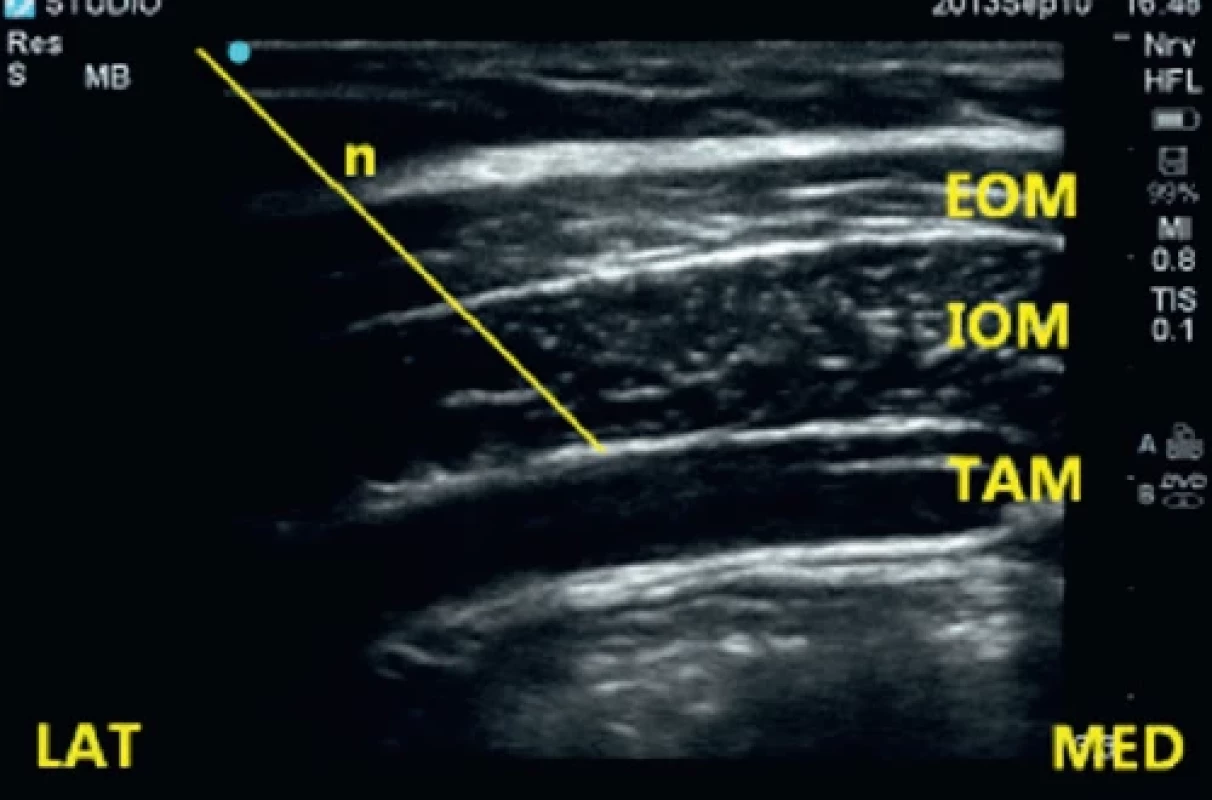 Technika ultrazvukem naváděného TAP bloku [28,29]. Sonda je položena horizontálně do Petitova trojúhelníku, zobrazeny m. obliquus abdominis externus, internus a transversus abdominis. Jehla je vedena IP technikou mezi hluboký šikmý sval a m. transversus abdominis.
