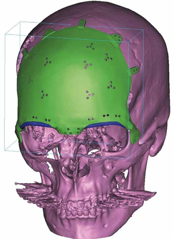 Plánovanie na počítači (volumetrická štúdia), stanovenie rozsahu resekcie a uchytenia titánového implantátu.
Fig. 5. The PC planning (volumetric study), determining the extent of tissue resection and anchoring points for titanium implants.