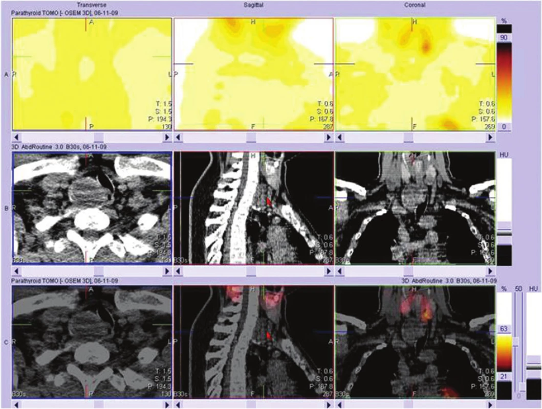 SPECT CT Tc MIBI
Fig. 1: SPECT CT TcMIBI