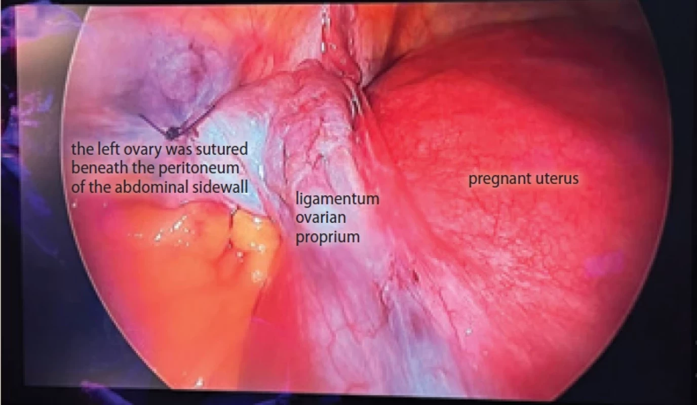The left ovary was sutured to the abdominal wall beneath the peritoneum following detorsion and cystectomy. Obr. 2. Levý vaječník byl po detorzi a cystektomii přišit k břišní stěně pod pobřišnicí.