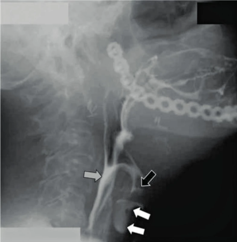 Dynamické CBCT, 18 snímků za sekundu, u pacienta, který podstoupil hemimandibulární resekci a rekonstrukci kovovou dlahou.