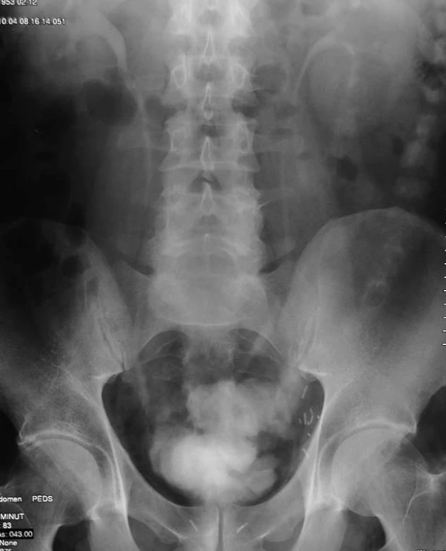 Motol pouch – vylučovací urografie.