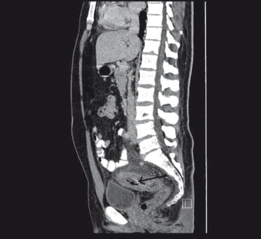 Stenóza střeva s prosáknutím stěny při CT zobrazení.
Fig. 3. Stenosis of the bowel with infiltration on the CT scan.