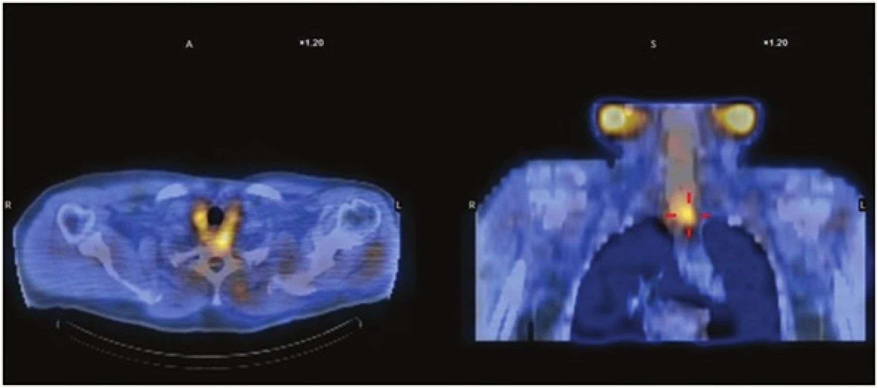 Scintigrafické vyšetření 99mTc MIBI SPECT/CT v roce 2011
Fig. 1: Examination of 99mTc MIBI-scintigraphy combinated with CT in year 2011