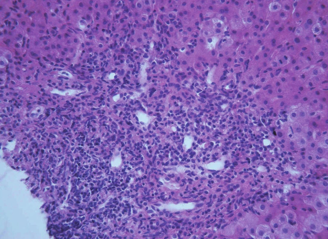 Obraz těžké chronické aktivní hepatitidy s výraznou interface aktivitou zánětu a navíc s duktulární proliferací u 15leté dívky s překryvným syndromem AIH-PSC.
Fig. 12. A picture of severe chronic active hepatitis with expressive interface activity and in addition with ductular proliferation in 15-year old girl with overlap syndrome AIH-PSC.