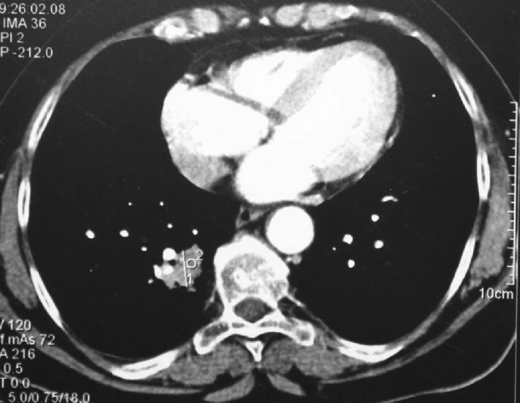 CT plic před provedením RFA – tumor v dolním laloku pravé plíce
Fig. 3: Lung CT before RFA – tumour in the lower lobe of the right lung