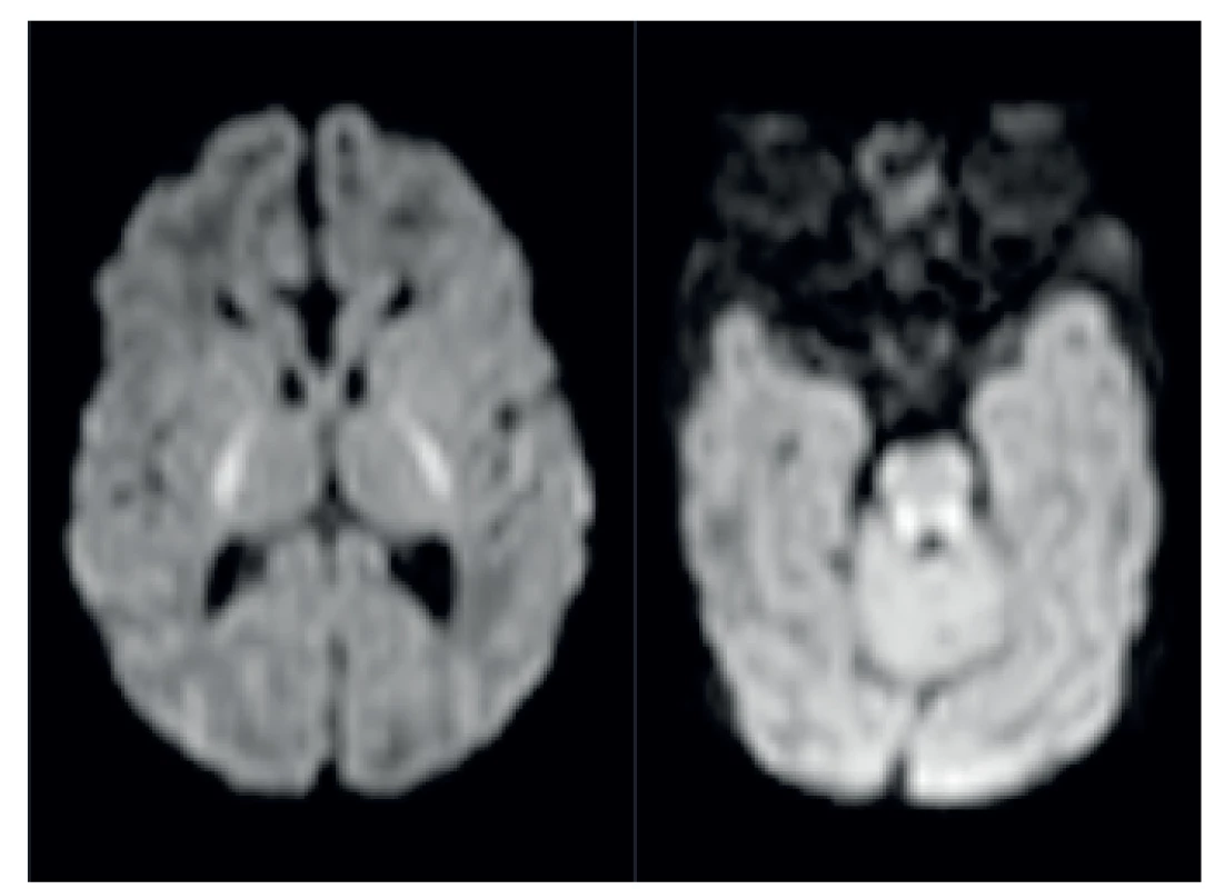 MR patologicky zvýšený signál symetricky v pontu a v oblasti horních a středních mozečkových pedunkulů.
Fig. 4. MRI pathologically high signal in pontus and midle pedunculus cerebellaris.