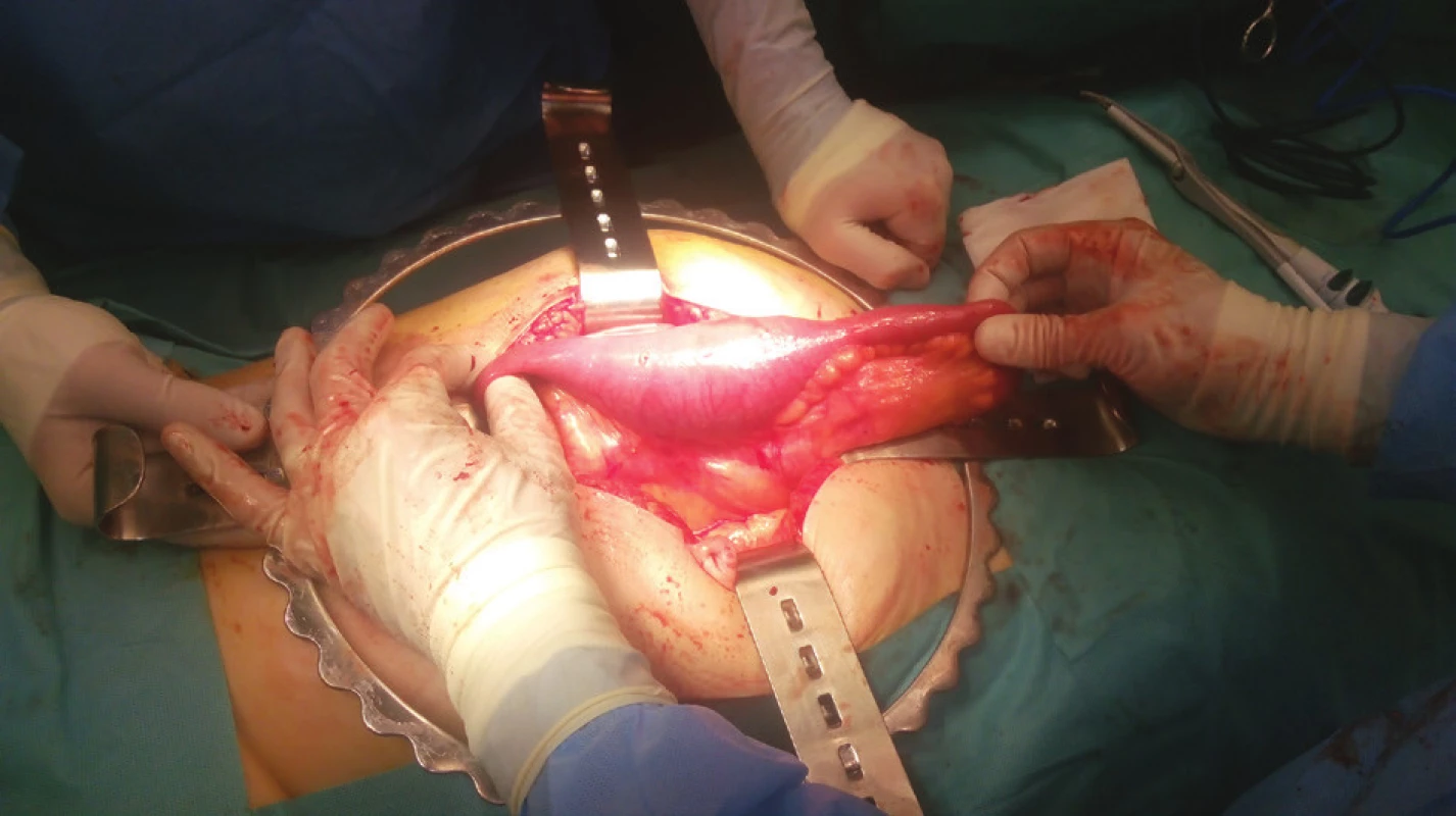 Peroperační obraz
Fig. 3: Perioperative image