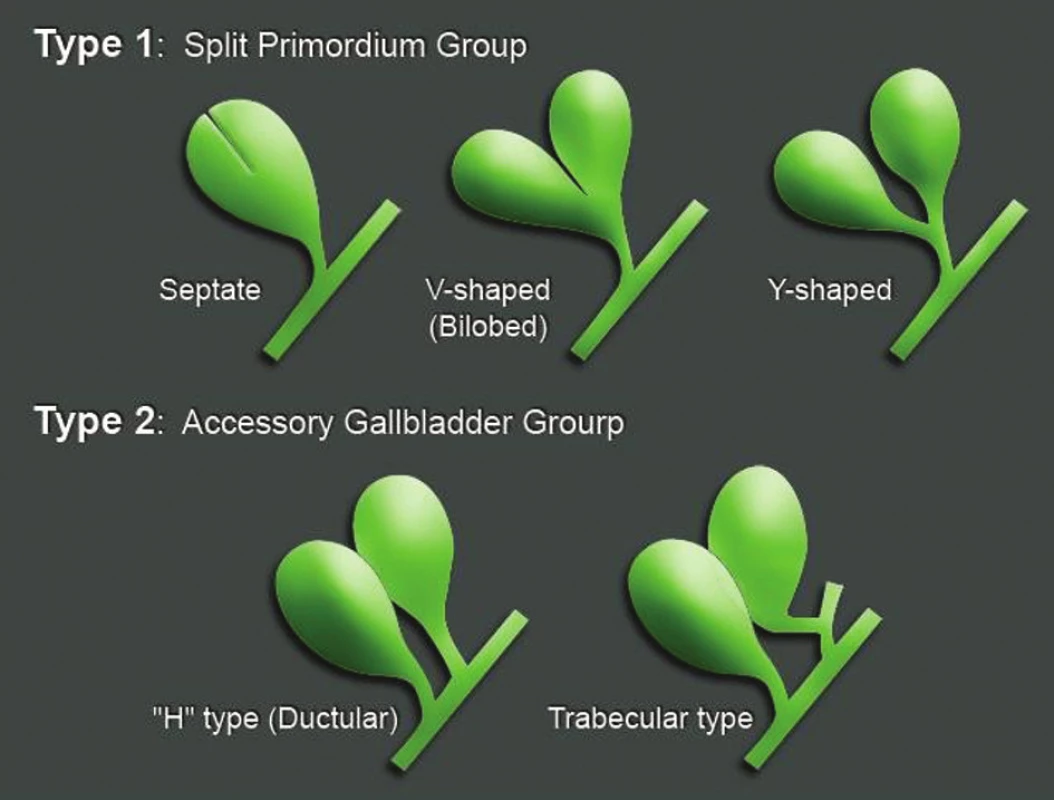 Boydenova klasifikace duplikatur žlučníku (převzato [5])
Fig. 1: Boyden’s classification of double gallbladders (taken from [5])