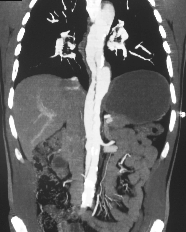 CTA rekonstrukce disekce typu B komplikované uzávěrem pravé renální tepny a pánevního řečiště oboustranně
Pic. 3. A CTA reconstruction of the type B dissection complicated by closures of the right renal artery and the pelvic vasculature bilaterally