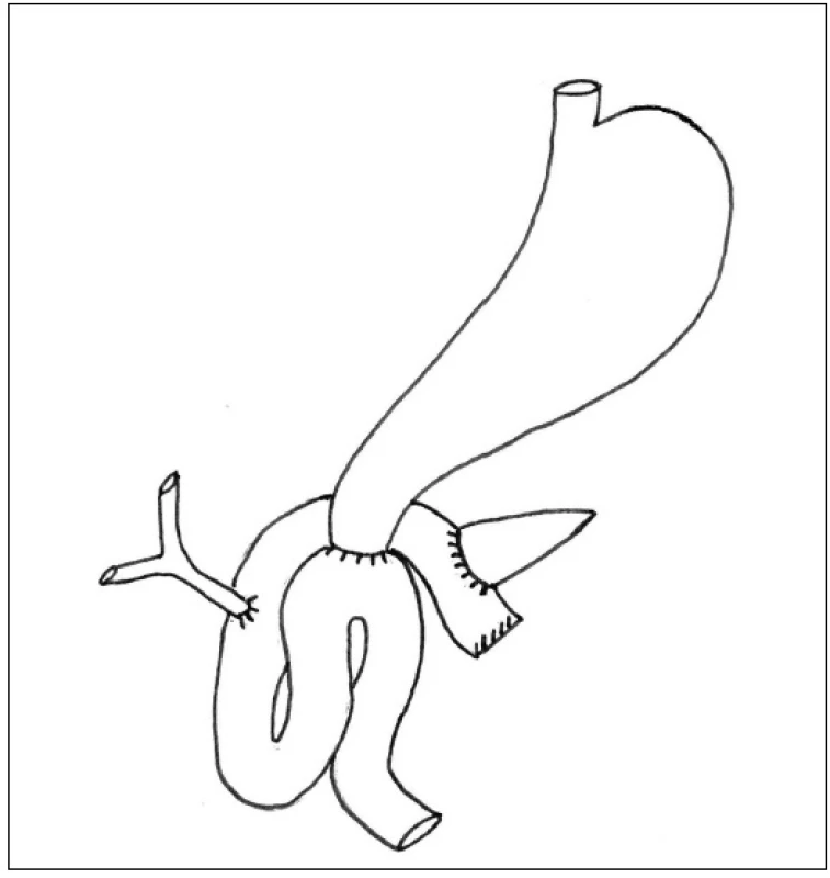 Námi standardně používaný typ rekonstrukce po PDE
Fig. 1: Standard type of PDE reconstruction