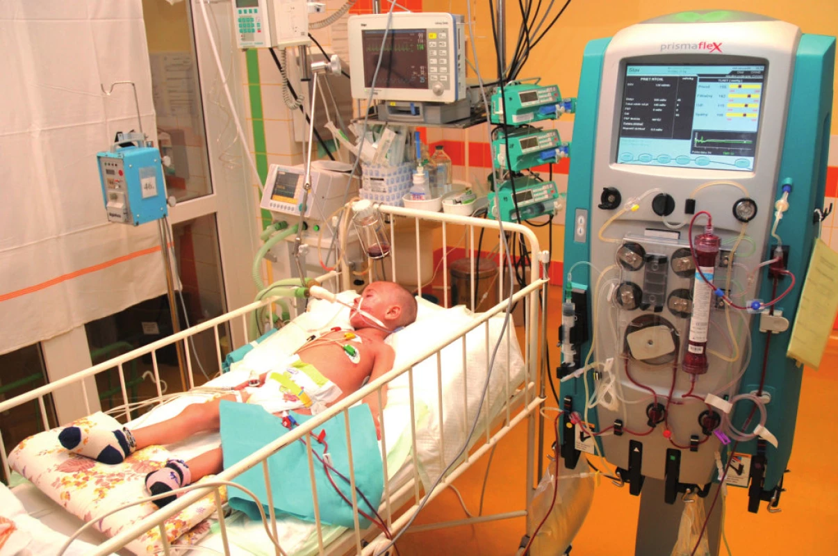 CVVHD (kontinuálna veno-venózna hemodialýza) u kriticky chorého dieťaťa.
Fig. 1. CVVHD in critically ill patient.