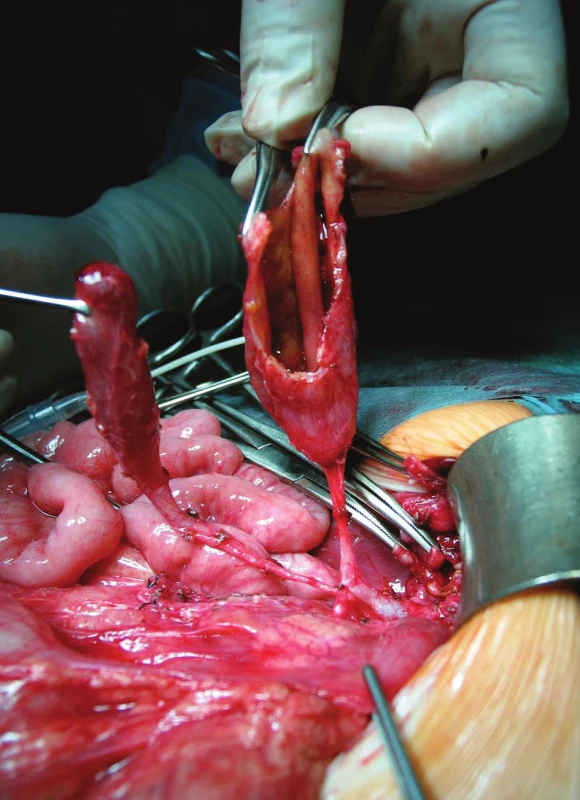 Otvorený lúmen multicysty vpravo, vľavo žlčník
s vlastným ústím do choledochu
Fig. 3. Multicyst with opened lumen on the right side, on the
left is gall-bladder with own choledochal junction