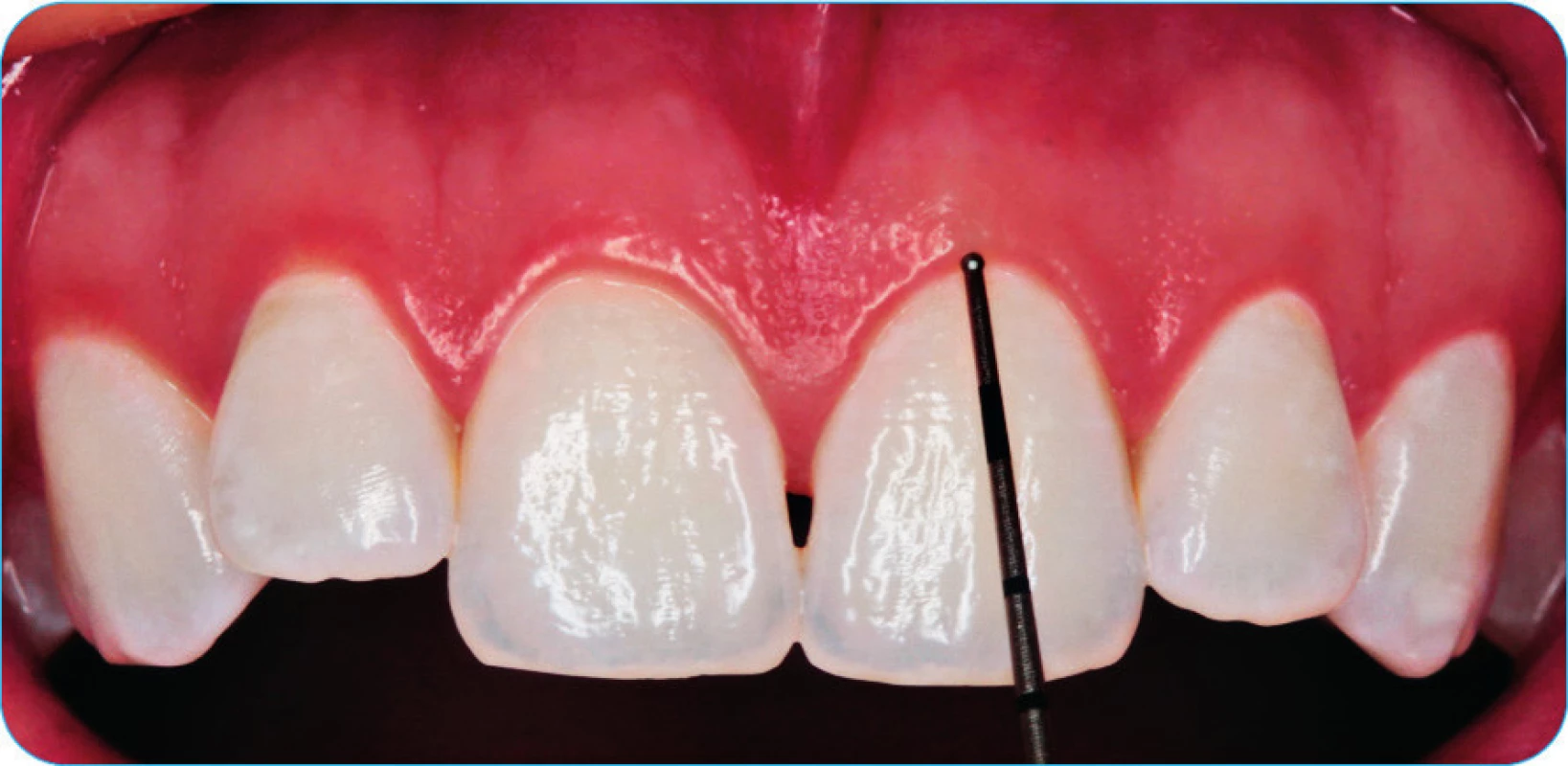 Intraorální fotografie frontálního úseku maxily – esteticky rušivý „black triangle“