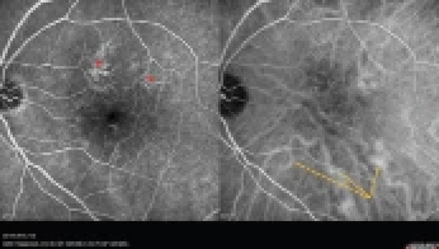 Simultánní fluoresceinový a indocyaninový angiografický snímek u 58letého pacienta s multifokální chronickou formou centrální serózní chorioretinopatie (Heidelberg Spectralis, Myslík Manethová):