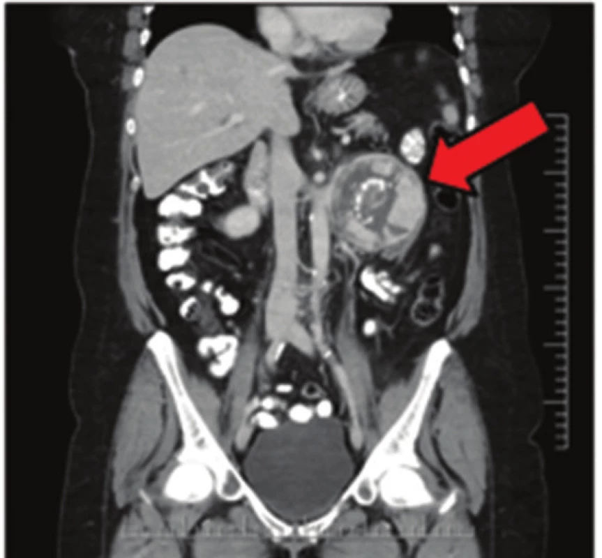Extraadrenální paragangliom na CT snímku
Fig. 3: Extraadrenal paraganglioma on CT scan