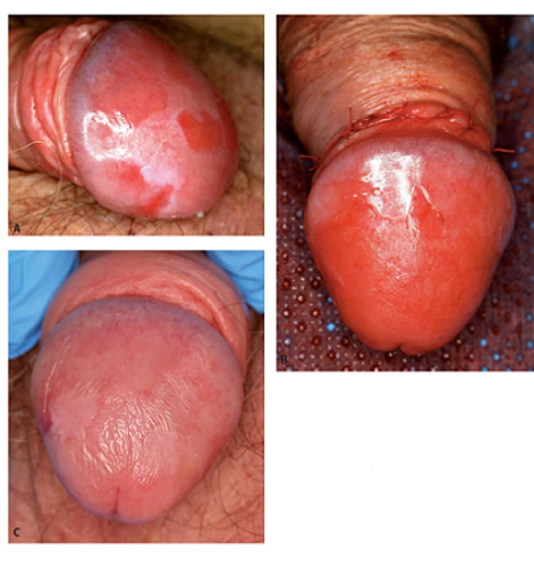 Muž, 81 let, simplexní PeIN (biopticky ověřený) na glans penisu: před léčbou (3A), bezprostředně po léčbě (cirkumcize a ablace s Er: YAG laserem – 3B) a 2 měsíce po výkonu (3C)
Fig. 3. Man, 81-year-old, simplex PeIN (histologically verified) of the glans penis: before (3A), immediately after treatment (circumcision and Er: YAG laser ablation – 3B) and 2 months after therapy (3C)