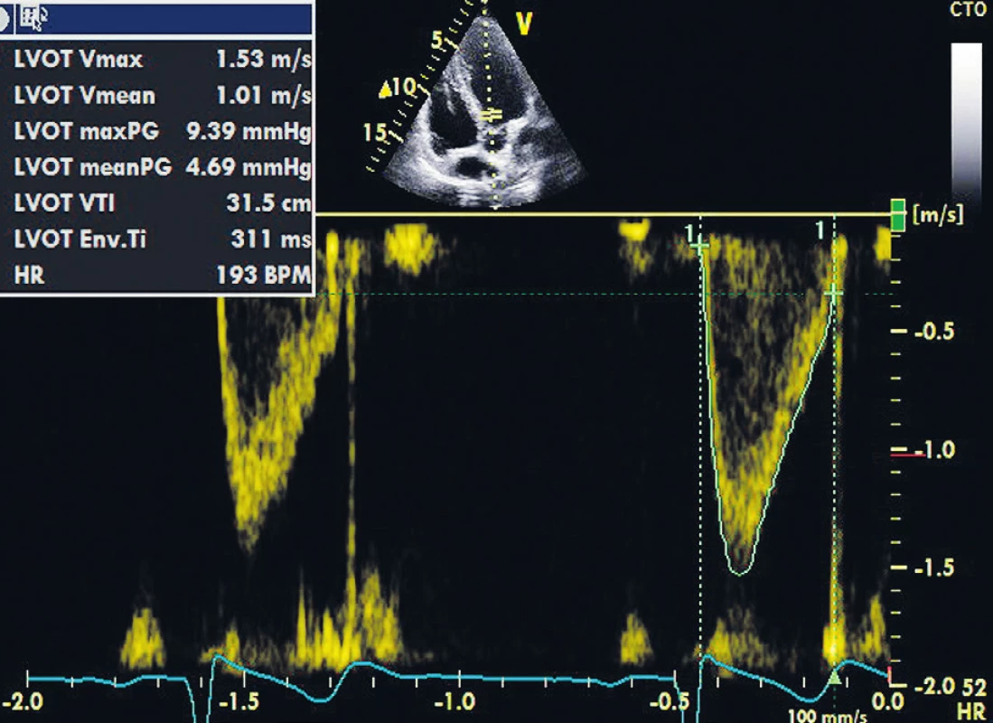 Měření VTI v LVOT
Nadprůměrná hodnota VTI 31,5 cm je daná sportovní anamnézou vyšetřovaného.