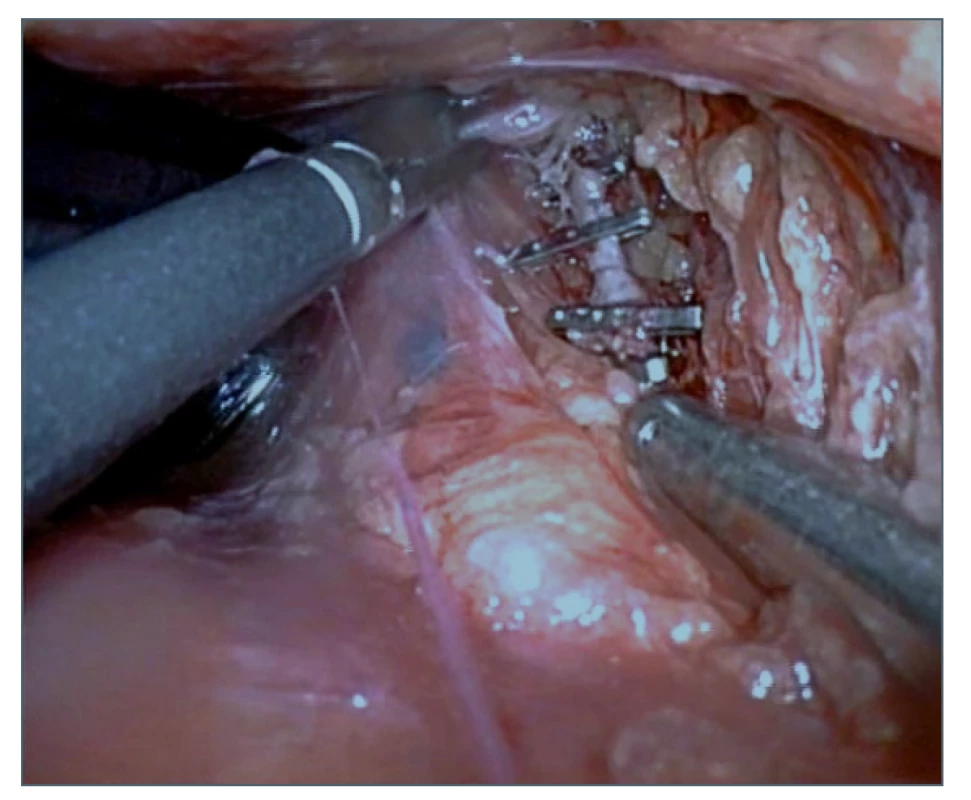 Zaklipování ductus thoracicus<br>
Fig. 6: Clipping of the thoracic duct