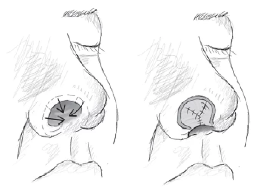 Overlapping lining fl ap. (Drawing by A. Berkeš according to [2]).