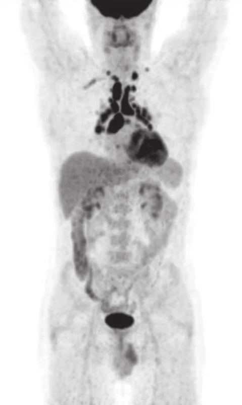Pacient č.1, I/2012 PET/CT (MIP).