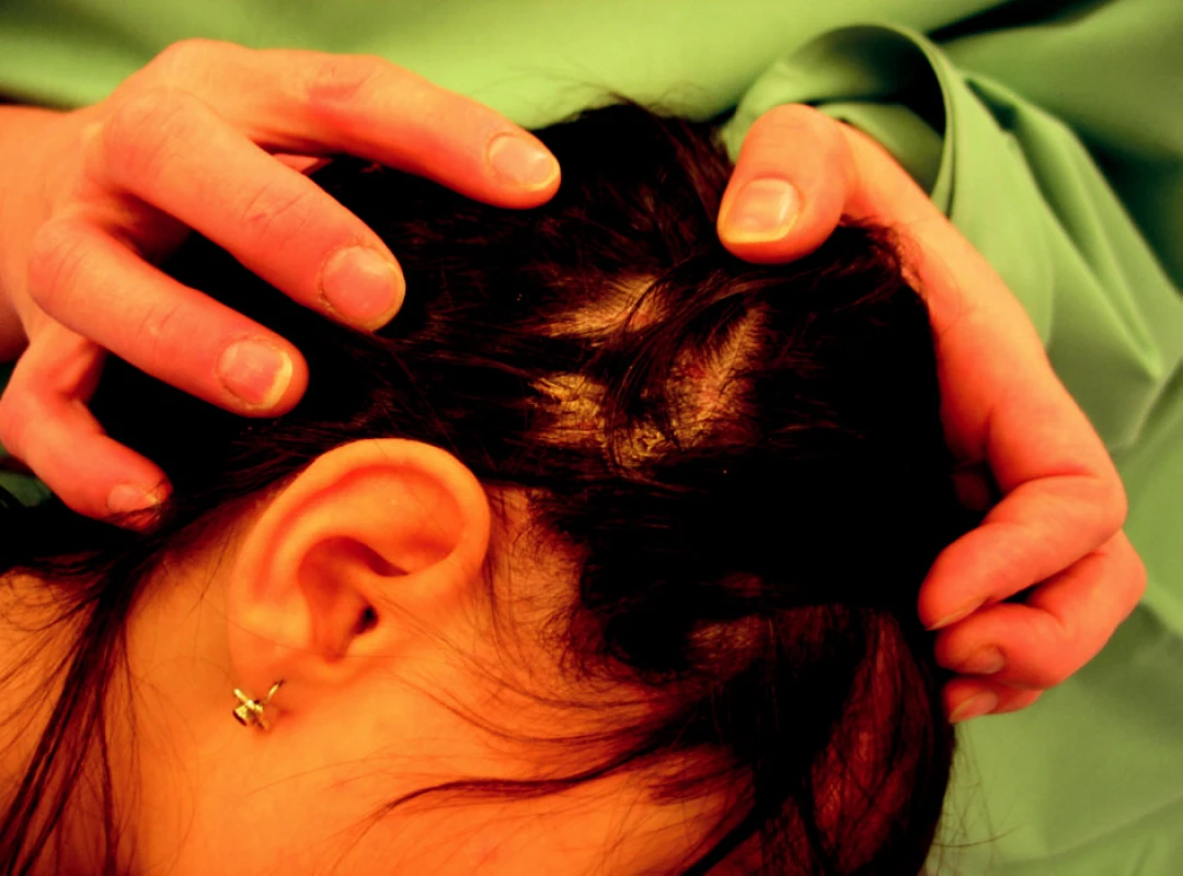 Psoriatická ložiska ve kštici.
Fig. 3. Psoriatic foci on the skull.