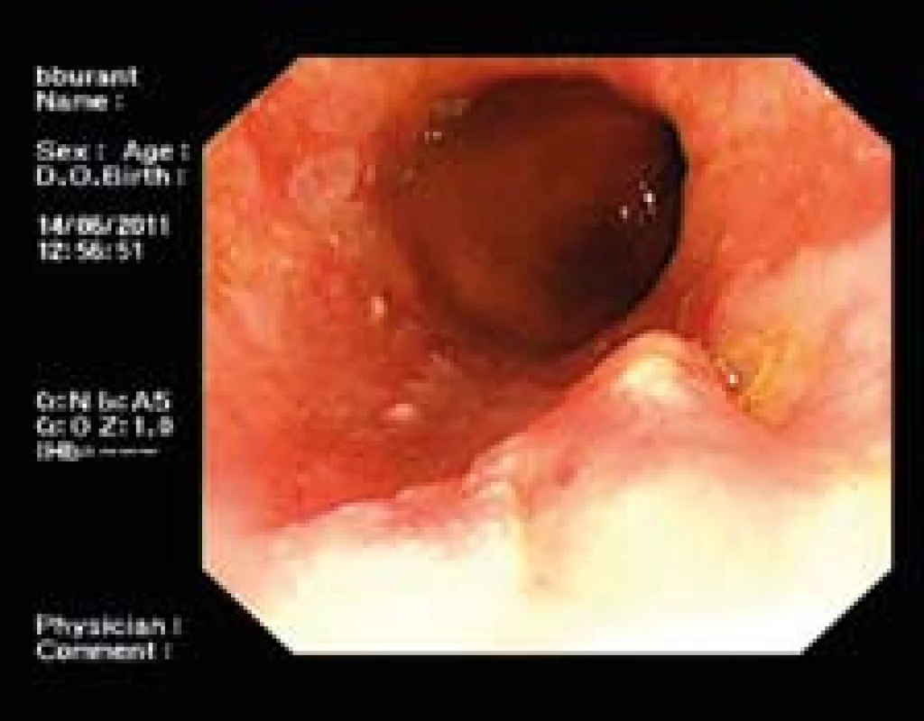 Pacient s prominující lézí. U tohoto (a jiných pacientů s viditelnou lézí) není indikovaná RFA, nýbrž ER.
Fig. 3. Patient with a prominent lesion. ER is indicated instead of RFA in this as well in other patients with a visible lesion.