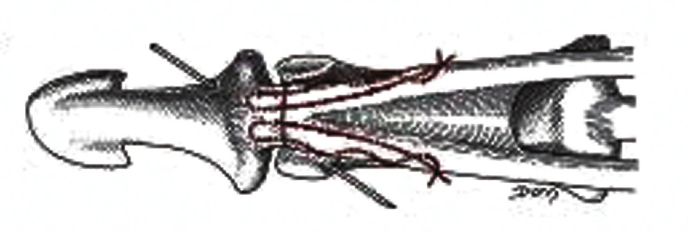 Reparácia terminálneho extenzora [2]
Fig 5: Reparation of the terminal extensor [2]