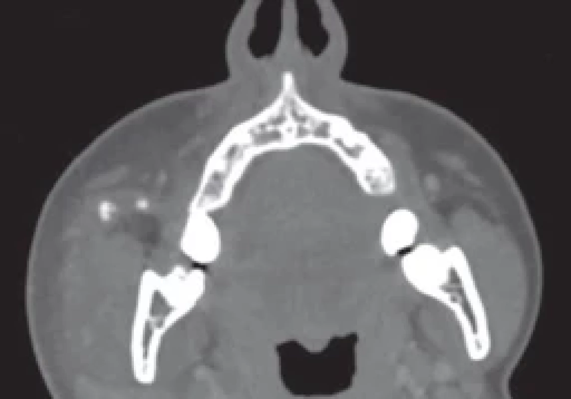 CT showing two sialoliths in the Stensen’s duct.